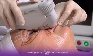عوامل مؤثر در ماندگاری هایفوتراپی