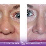 عکس قبل و بعد هایفوتراپی بینی گوشتی