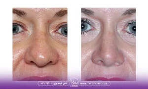 عکس قبل و بعد هایفوتراپی بینی گوشتی
