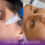 هایفوتراپی بهتره یا میکرونیدلینگ