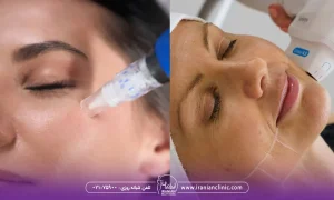 هایفوتراپی بهتره یا میکرونیدلینگ