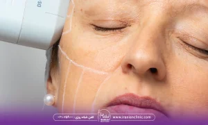 عملکرد امواج اولتراسوند در از بین بردن لک های پوستی