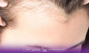 هایفوتراپی مو چیست و چگونه عمل می کند؟