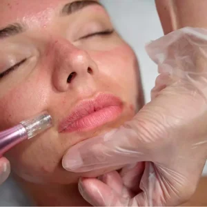 میکرونیدلینگ ۳ جلسه با تخفیف ده میلیونی