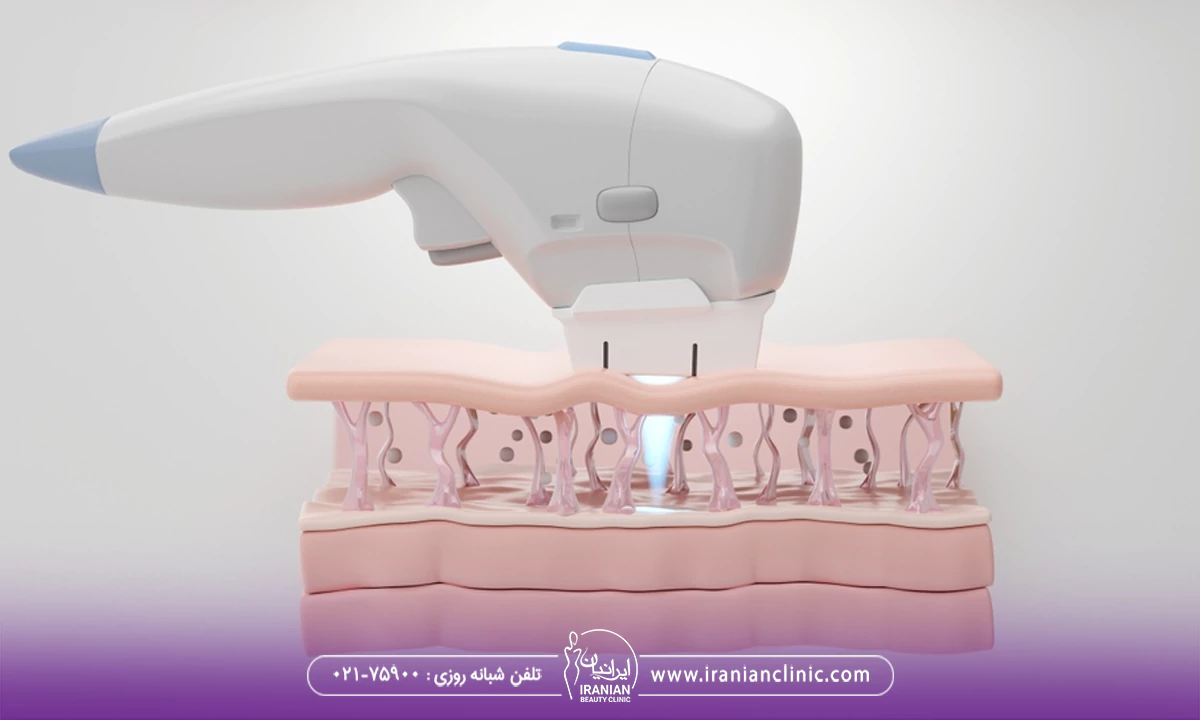 نقش دستگاه های پیشرفته در موفقیت مرکز هایفوتراپی در غرب
