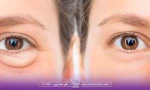 فواید هایفوتراپی برای پف زیر چشم