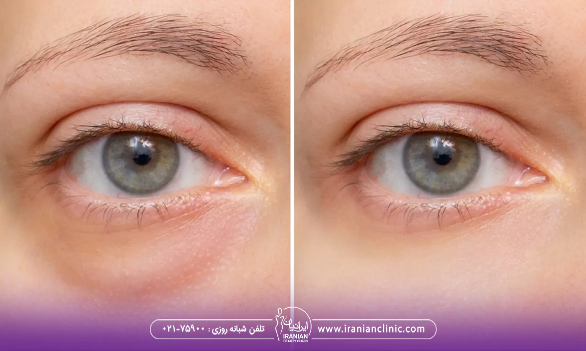 کاربردهای هایفوتراپی برای پف زیر چشم