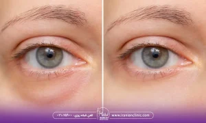 کاربردهای هایفوتراپی برای پف زیر چشم