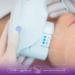 خانمی که هایفو صورت انجام می دهد و مراقبت های بعد از هایفوتراپی صورت را می پرسد