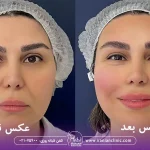 عکس قبل و بعد هایفوتراپی در کلینیک زیبایی ایرانیان