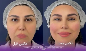 عکس قبل و بعد هایفوتراپی در کلینیک زیبایی ایرانیان