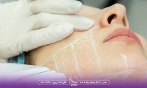 از فواید هایفوتراپی ماندگاری هایفوتراپی برای صورت