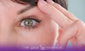 هایفوتراپی برای افتادگی پلک و درمان افتادگی پلک با هایفوتراپی