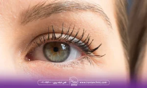 مقایسه قیمت هایفوتراپی دور چشم با نواحی دیگر