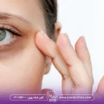 هایفو برای گودی زیر چشم چیست و چگونه انجام می شود؟