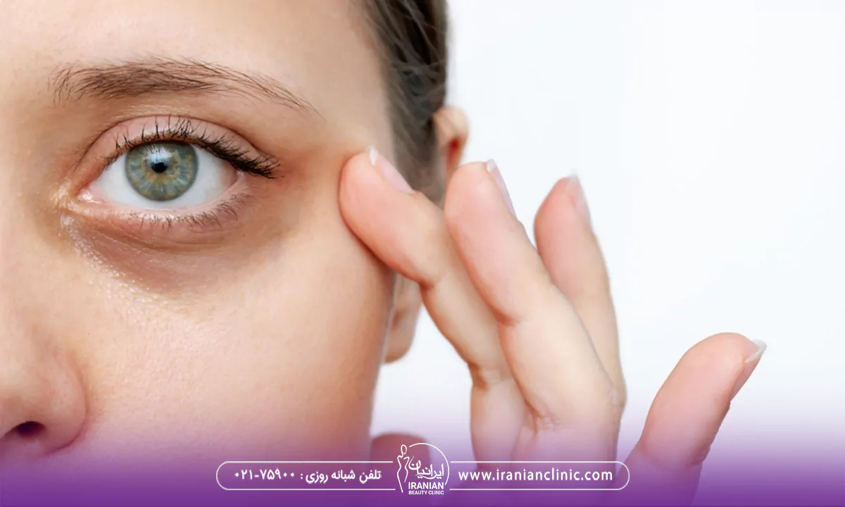 هایفو برای گودی زیر چشم چیست و چگونه انجام می شود؟