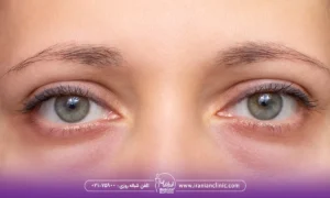 هایفوتراپی برای پف زیر چشم