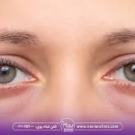 هایفوتراپی برای پف زیر چشم