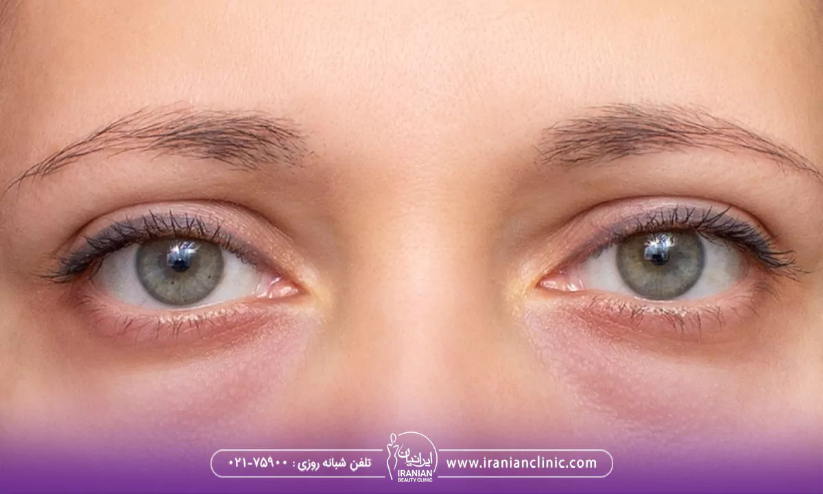 هایفوتراپی برای پف زیر چشم