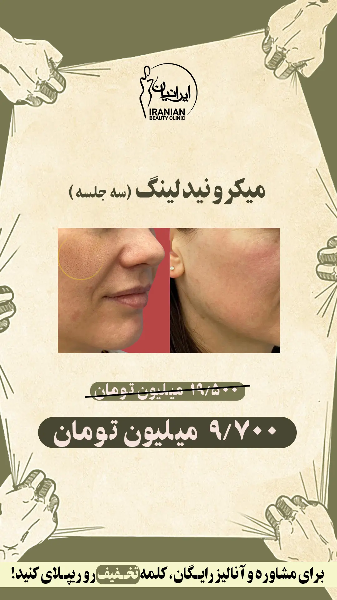 میکرونیدلینگ (1)