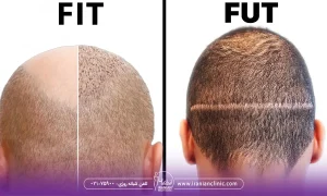 کاشت مو به روش fit بهتر است یا fut