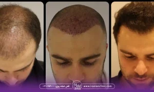 عوامل مؤثر بر هزینه کاشت مو به روش FIT