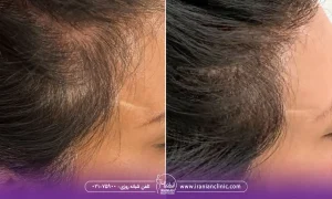  عوامل موثر در قیمت کاشت مو برای زنان