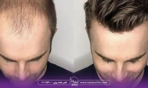 روش‌های کاشت در بهترین مرکز کاشت مو شرق تهران