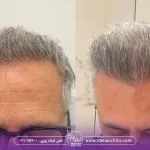 بهترین مرکز کاشت مو در شمال تهران