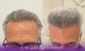 بهترین مرکز کاشت مو در شمال تهران