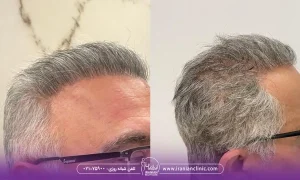 روش های کاشت در بهترین مرکز کاشت مو شمال تهران، عکس قبل و بعد کاشت مو کلینیک زیبایی ایرانیان