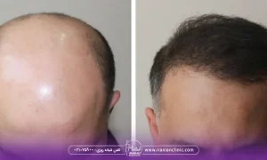 معیارهای انتخاب بهترین مرکز کاشت مو شمال تهران