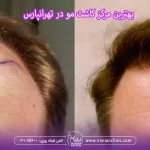 بهترین مرکز کاشت مو در تهرانپارس