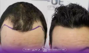 روش های کاشت در بهترین مرکز کاشت مو در تهرانپارس