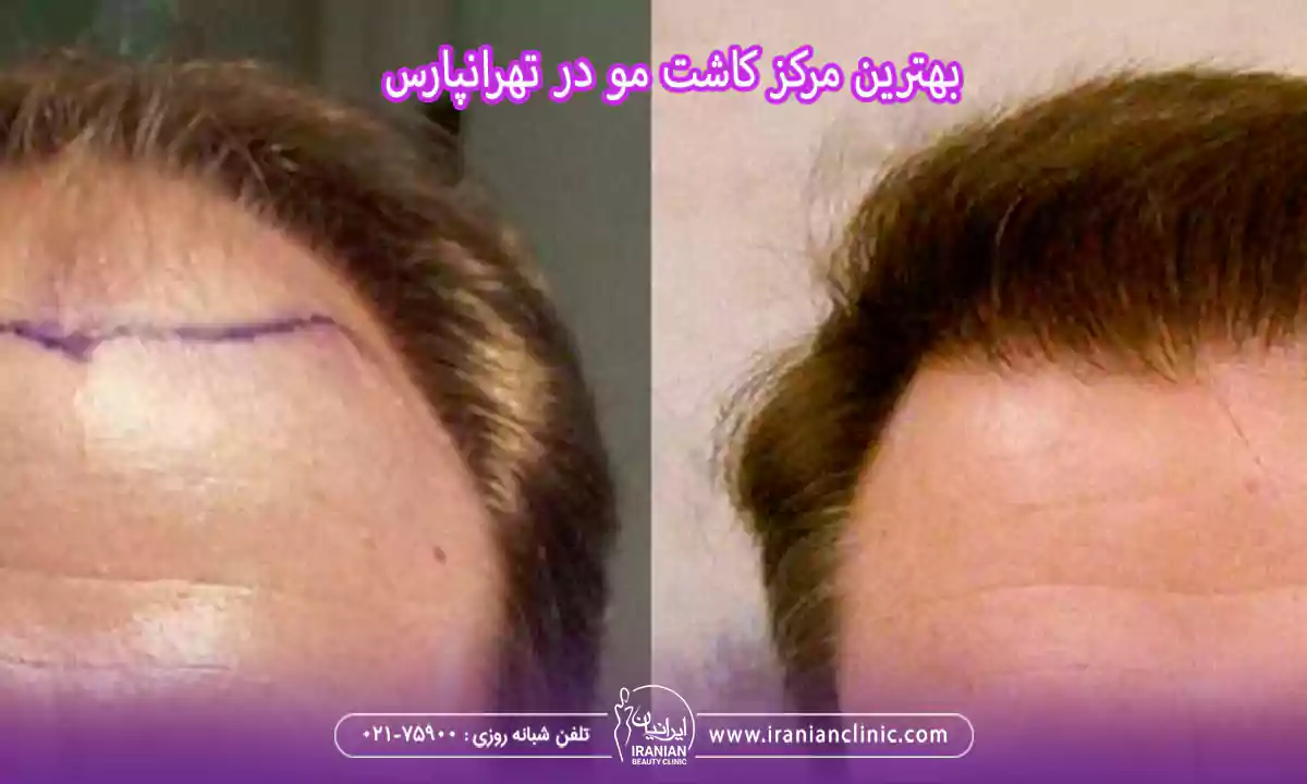 بهترین مرکز کاشت مو در تهرانپارس