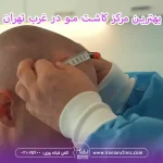 بهترین مرکز کاشت مو در غرب تهران