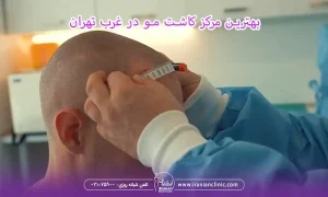 بهترین مرکز کاشت مو در غرب تهران