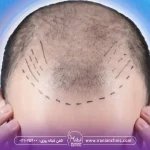 hair-transplant-bht-cost