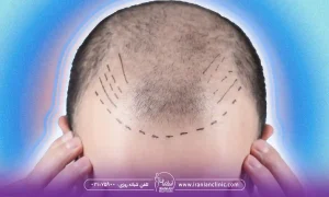 hair-transplant-bht-cost