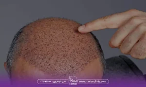 قیمت هر گرافت و هر تار مو در روش BHT