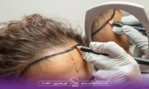 عوامل مؤثر بر هزینه کاشت مو به روش BHT