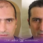 قیمت کاشت مو به روش fit و هزینه کاشت مو به روش FIT