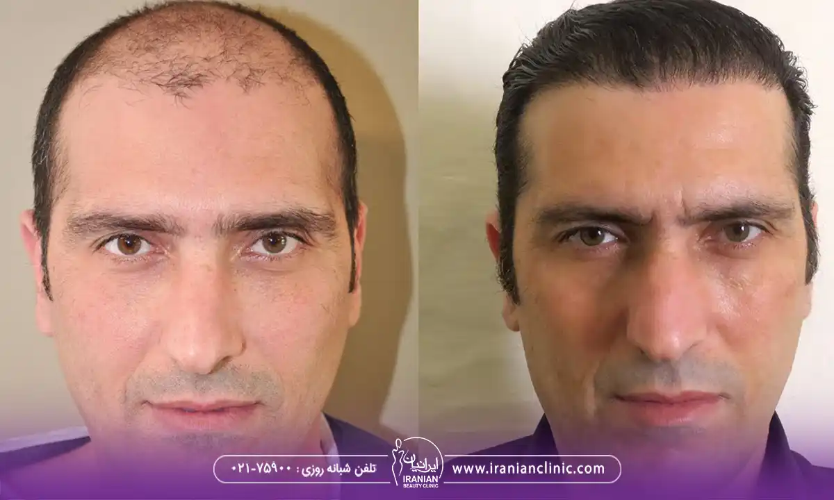 قیمت کاشت مو به روش fit و هزینه کاشت مو به روش FIT