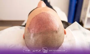 قیمت کاشت مو به روش fue و هزینه کاشت مو به روش FUE