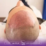 قیمت کاشت مو به روش fue و هزینه کاشت مو به روش FUE