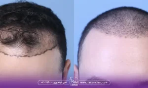 عوامل مؤثر بر هزینه کاشت مو به روش fue