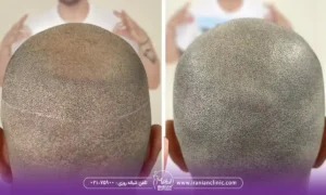 قیمت کاشت مو به روش fut و هزینه کاشت مو به روش FUT