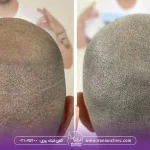 قیمت کاشت مو به روش fut و هزینه کاشت مو به روش FUT