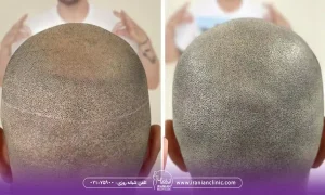 قیمت کاشت مو به روش fut و هزینه کاشت مو به روش FUT