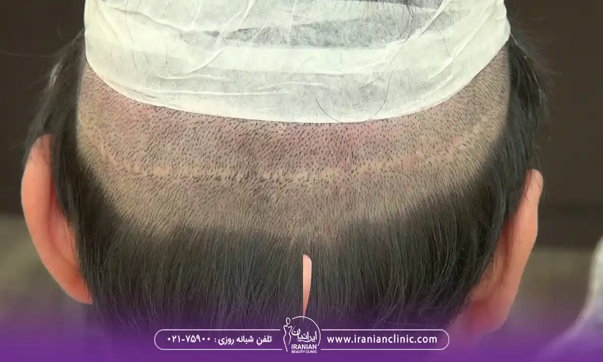تفاوت قیمت کاشت مو fut در تهران و سایر شهرها